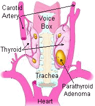 Hiperparatiroidismo y enfermedad de las glandulas paratiroides : un tumor.