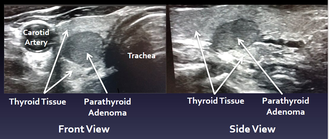 Intra-thyroidal Parathyroid Adenoma with Dr. Jamie Mitchell_2