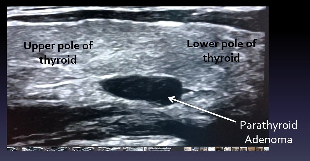 Interesting case of the week 11/19/21: Recognizing Non-Classic Lab Values in Patients with Primary #Hyperparathyroidism with Dr. Jamie Mitchell  2