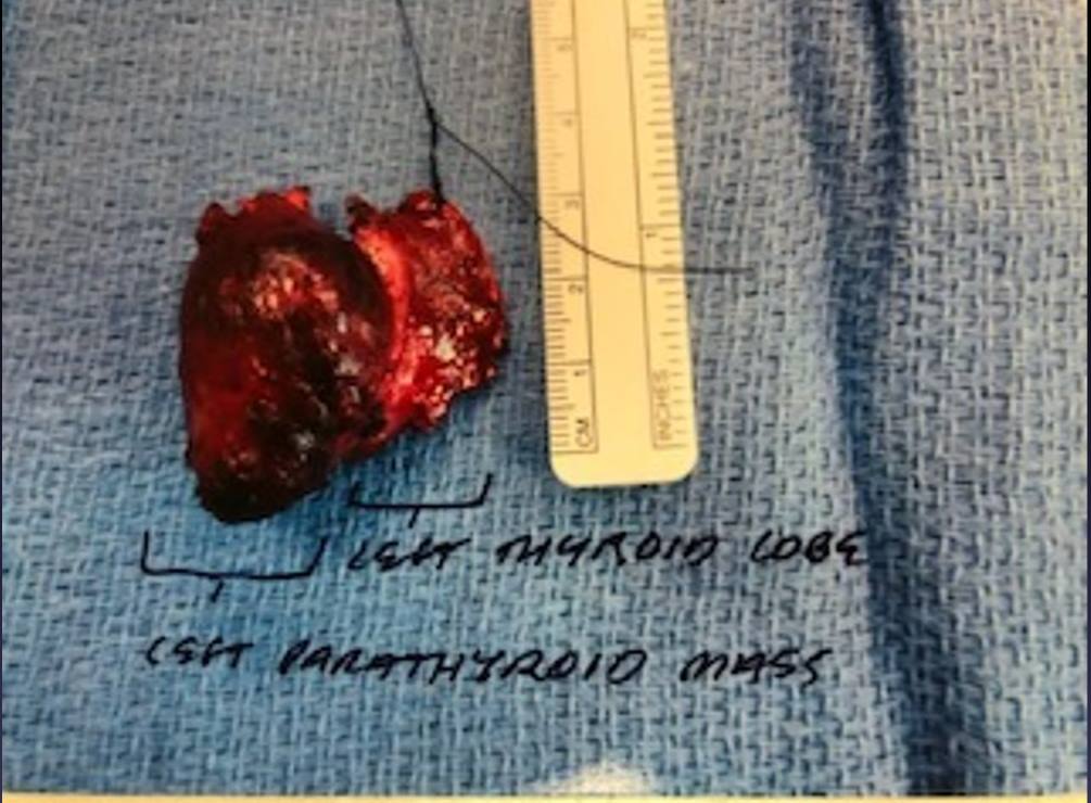 Interesting case of the week: Parathyroid Carcinoma Presenting As Recurrent Primary Hyperparathyroidism with Dr. Jamie Mitchell 2