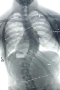 Severe scoliosis and osteoporosis caused by hyperparathyroidism in 15 year old boy.