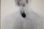 Sestamibi scan showing large thyroid nodule