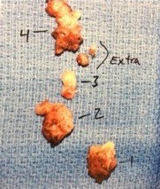 Parathyroid tumor