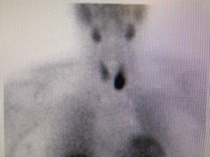 Sestamibi scan showing large parathyroid tumor" alt="Huge parathyroid tumor causing depression, anger, fatigue, and rage.