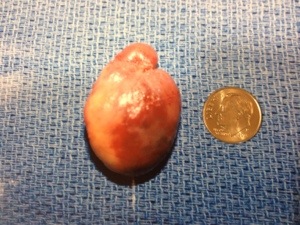 Huge parathyroid adenoma causing depression and anger problems." alt="Fatigue, depression and anger problems are common symptoms of hyperparathyroidism.