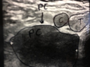 Parathyroid cyst shown on ultrasound. PC =  Parathyroid Cyst.; C =  carotid artery; T = thyroid gland.