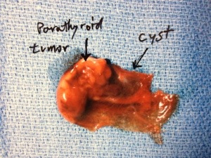 Parathyroid cyst showing ruptured cyst wall and attached parathyroid adenoma.