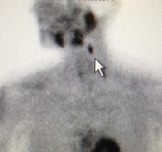 Ectopic parathyroid adenoma under jaw easy to see on sestamibi scan.