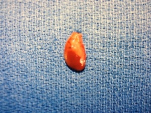 Carole's undescended ectopic parathyroid tumor.