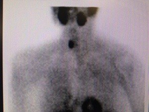 Renal failure caused by high blood calcium. Primary hyperparathyroidism and nephrocalcinosis