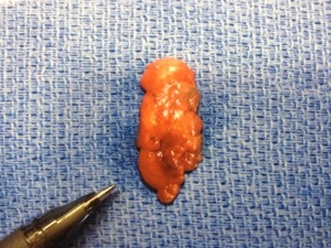 Parathyroid Adenoma caused by radioactive iodine ablation