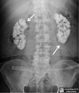 Kidney failure due to nephrocalcinosis: Calcium deposits in the kidneys causing the kidneys to shut down and fail