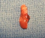 High blood calcium is almost always caused by parathyroid tumors.