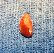 Parathyroid surgery will find one parathyroid adenoma in 70% of patients with hyperparathyroidism.