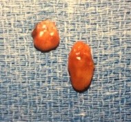 Two parathyroid adenomas are seen in about 20% of people with primary hyperparathyroidism.