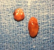 PTH Tests cannot find multiple parathyroid adenomas (parathyroid tumors)