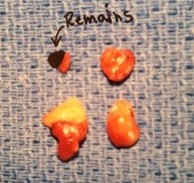 Four gland parathyroid hyperplasia causing hyperparathyroidism.