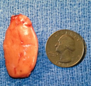 Even though they are not parathyroid cancer, these tumors take a long time to grow this large. Remember: they start out the size of a grain of rice!