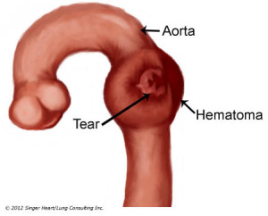 Aortic dissection as a cause of race car driver's deaths.