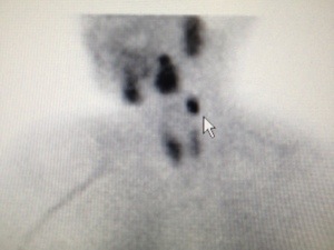 Large ectopic parathyroid tumor under left jaw on sestamibi scan.