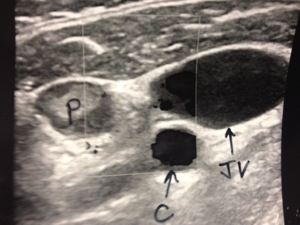 Ultrasound of undescended ectopic parathyroid tumor left neck.