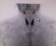 Left upper ectopic parathyroid adenoma