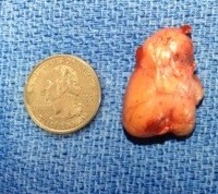 Parathyroid drugs don't exist, but even if they did, they wouldn't have a chance against this huge tumor!