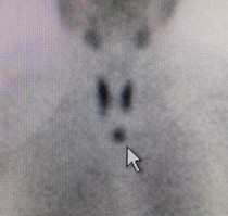 Parathyroid tumor in the upper chest.