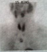 Parathyroid gland in the chest.