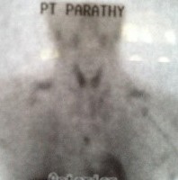 Chest parathyroid tumor