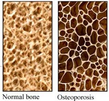 Osteoporosis can be caused by hyperparathyroidism and parathyroid tumors so ask your endocrinologist.