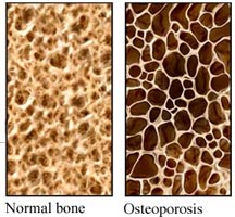 https://www.parathyroid.com/blog/wp-content/uploads/2013/05/20130517-111210-e1376451822480.jpg