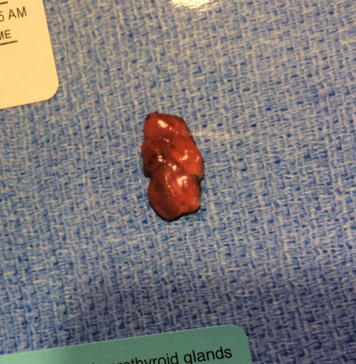 Parathyroid tumor removed at Norman Parathyroid Center after unsuccessful parathyroidectomy.