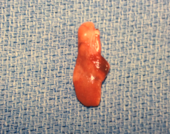 Parathyroid Adenoma at the Norman Parathyroid Center.