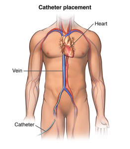 Parathyroid venous sampling catheter is put into the femoral vein in the groin and pushed up to the chest and into the neck.