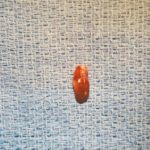 parathyroid adenoma in child