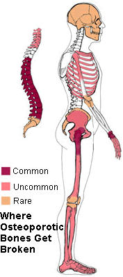 Osteoporosis caused by hyperparathyroidism and parathyroid problems.