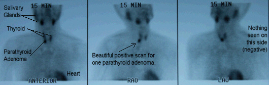 Positive sestamibi scan showing deep right upper parathyroid adenoma, a normal thyroid, and nothing else.