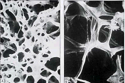 Normal bone on LEFT, and Osteoporosis bone on RIGHT due to Hyperparathyroidism.