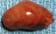 parathyroid gland adenoma photo