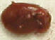 parathyroid adenoma picture