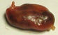 parathyroid adenoma picture