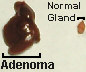 parathyroid adenoma picture