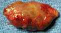 parathyroid gland adenoma photo