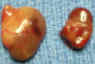 parathyroid gland adenoma photo