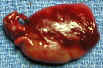 parathyroid gland adenoma photo