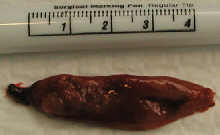 large parathyroid adenoma