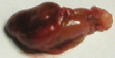 parathyroid adenoma