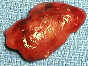 parathyroid adenoma picture