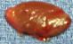 parathyroid adenoma picture